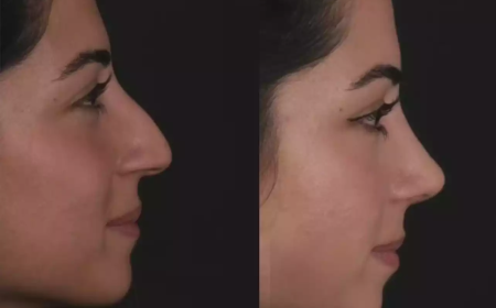 Best Septoplasty Surgeon in Dubai: Transforming Lives Through Expert Care
