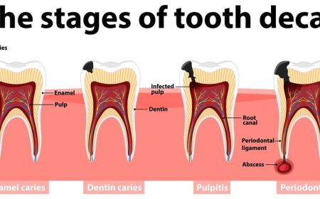 What Are Root Canals and Why You Shouldn’t Fear Them