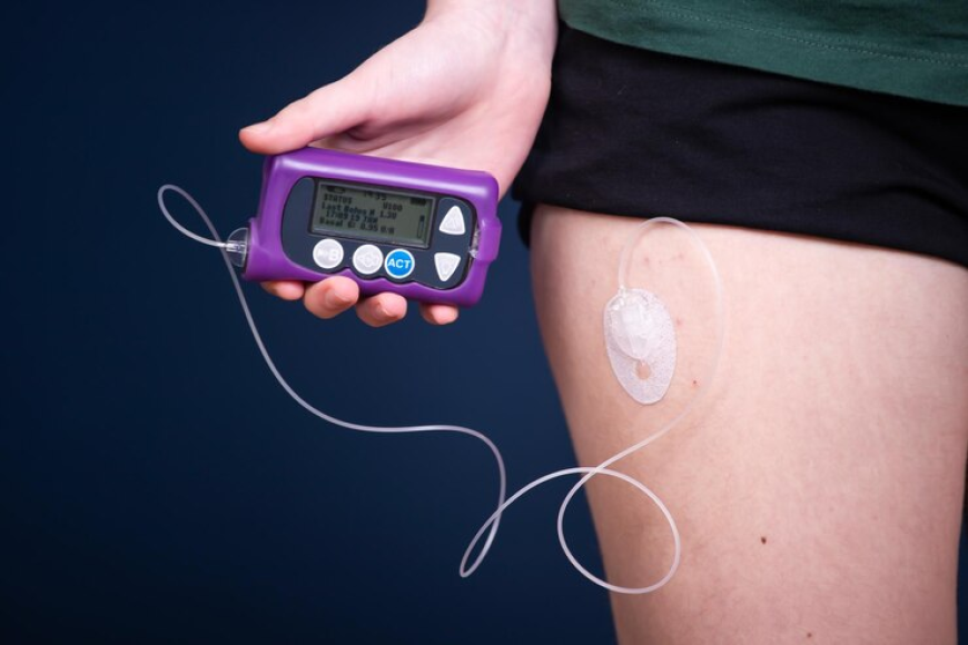 Insulin Infusion Pumps Market: Trends, Growth, and Future Outlook