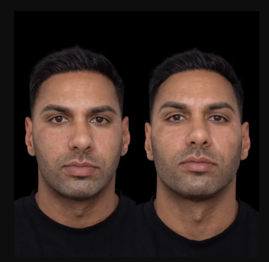 Are Sculptra Fillers in Dubai Safe? Myths, Facts, and Expert Insights