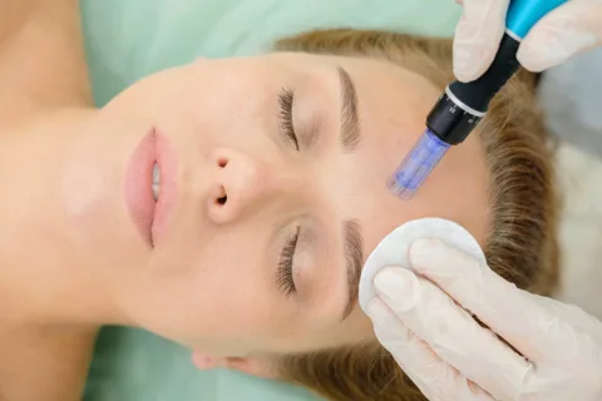 Affordable Microneedling Treatments in the USA | Glowing Skin Within Reach
