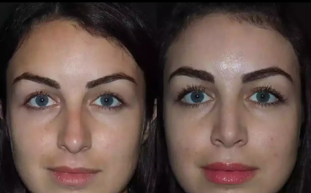 Best Rhinoplasty Surgeons in Dubai: Trusted and Proven