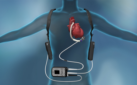 Heart Pump Device Market: Advancing Cardiac Care with Innovative Solutions