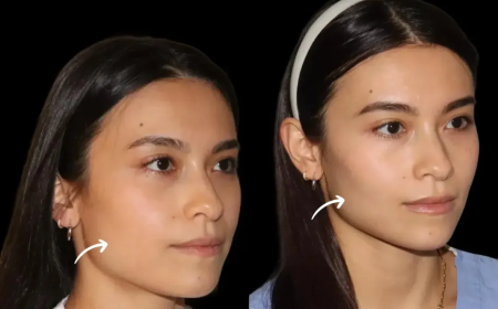 How Dubai's Best Aesthetic Clinic Personalizes Sculptra Fillers Treatments by Face Shape