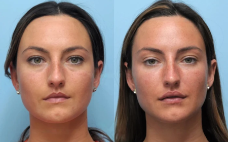 Choosing the Best Plastic Surgeon in Dubai for Thread Lift Procedures