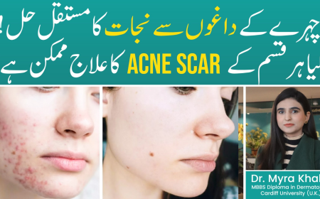 Best Acne Scar Treatments in Pakistan for Smooth, Clear Skin