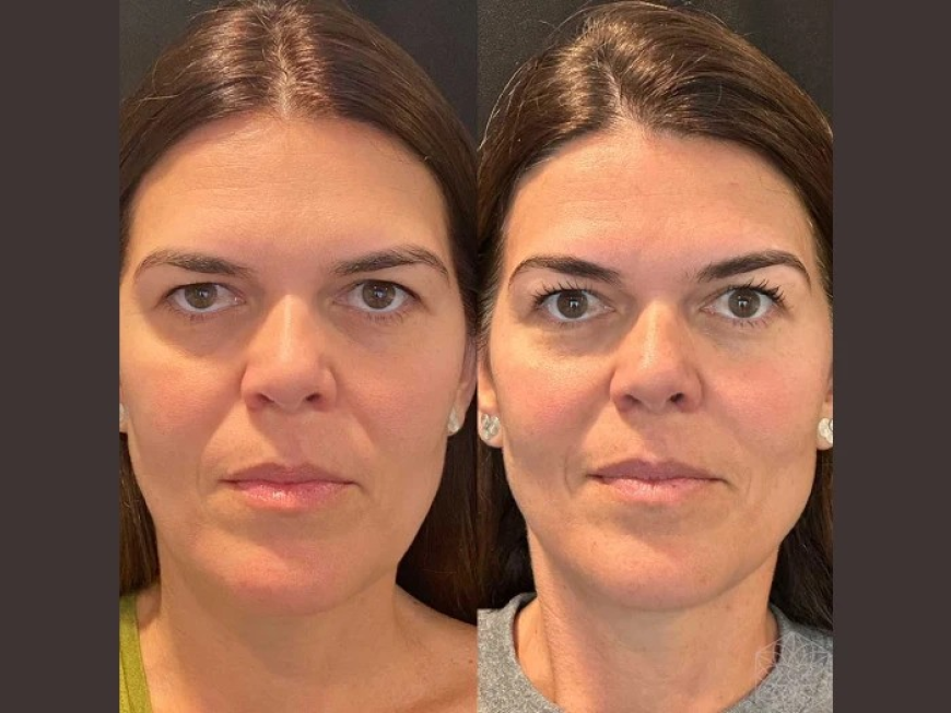 Thread Lift Treatment in Dubai: The Ideal Solution for Mild to Moderate Aging Signs