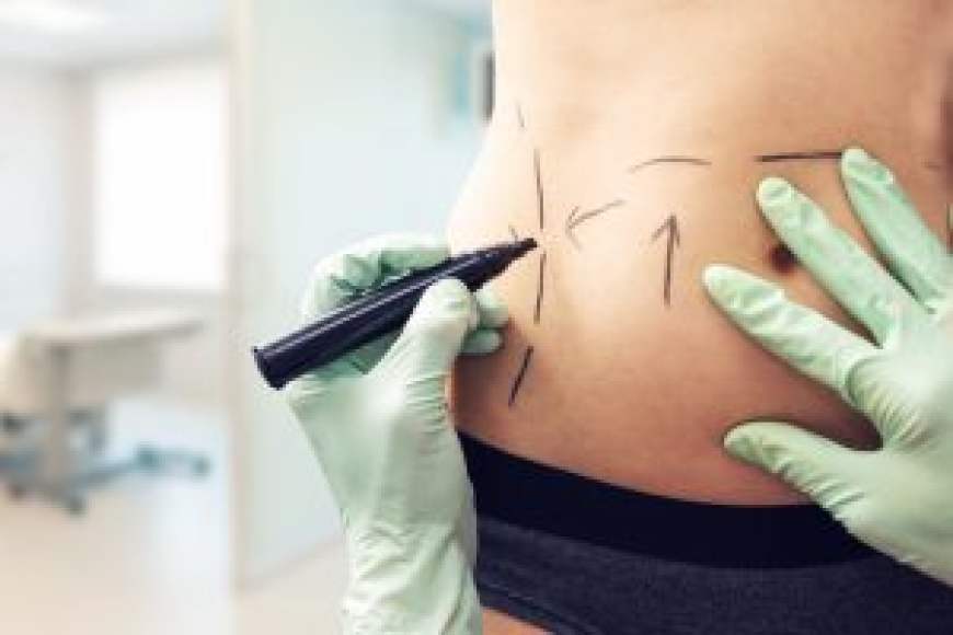 The Ultimate Guide to Tummy Tuck Surgery in Dubai