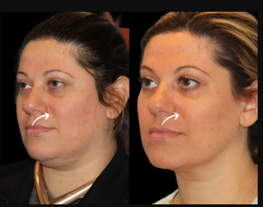 Natural Results with Sculptra Fillers in Dubai: Why Collagen Boosting Matters