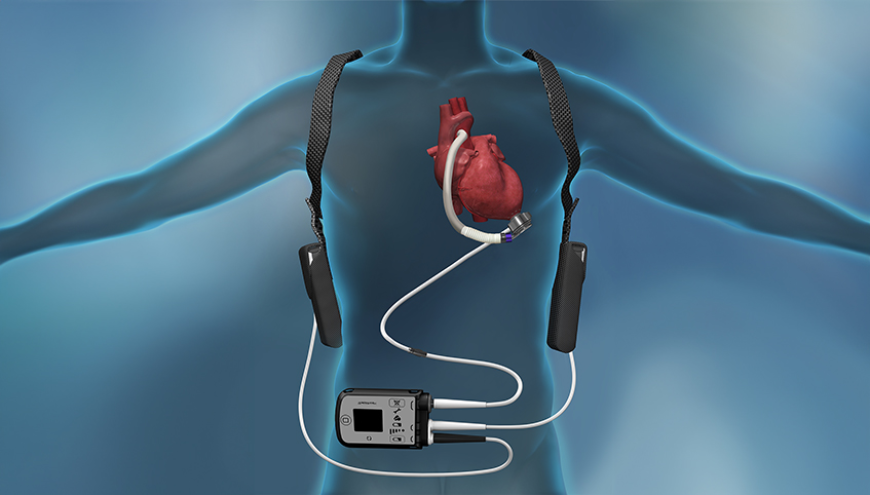 Heart Pump Device Market: Advancing Cardiac Care with Innovative Solutions
