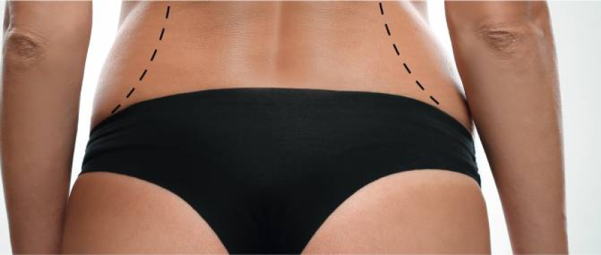 Body Contouring in Dubai: The Ultimate Guide to a Sculpted Physique