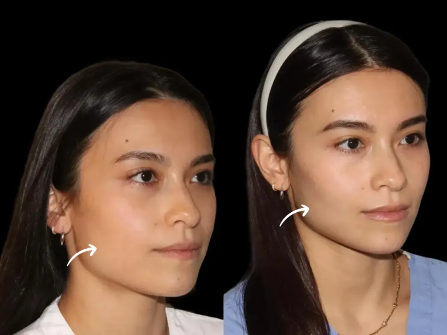 How Dubai's Best Aesthetic Clinic Personalizes Sculptra Fillers Treatments by Face Shape