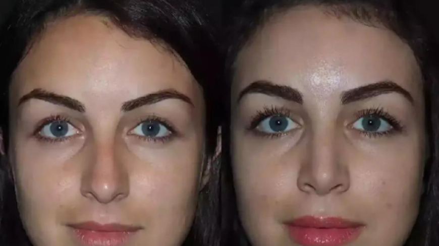 Affordable Excellence: Finding the Best Rhinoplasty Surgeon in Dubai