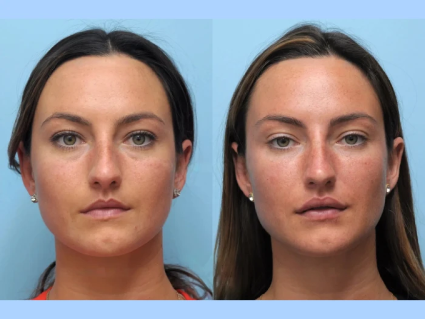 Thread Lift Innovations at the Best Aesthetic Clinics in Dubai