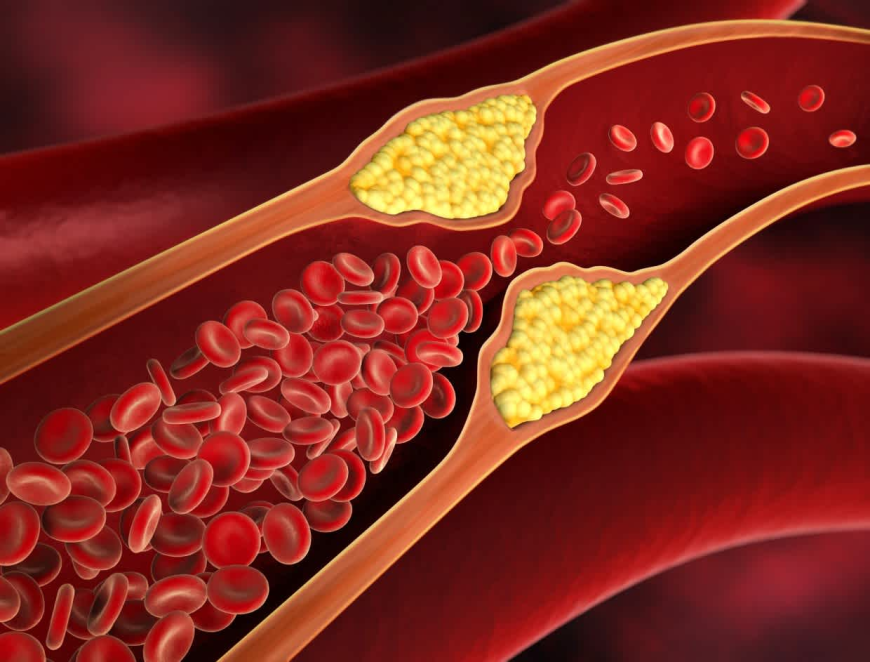 The Role of Diet and Lifestyle in Controlling High Cholesterolemia in Dubai