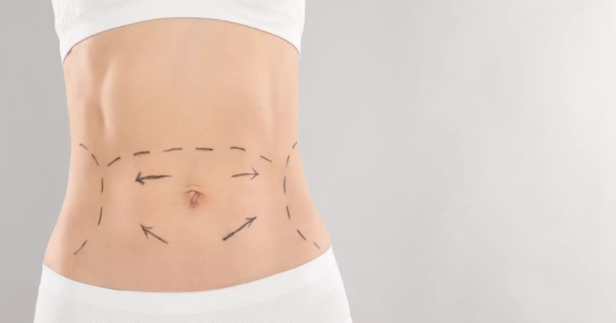 Tummy Tuck Dubai: Understanding the Different Types of Tummy Tuck Procedures