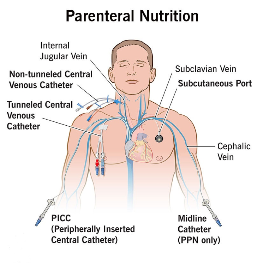 Parenteral Nutrition Market Focus on Sustainable and Waste-Reducing Packaging