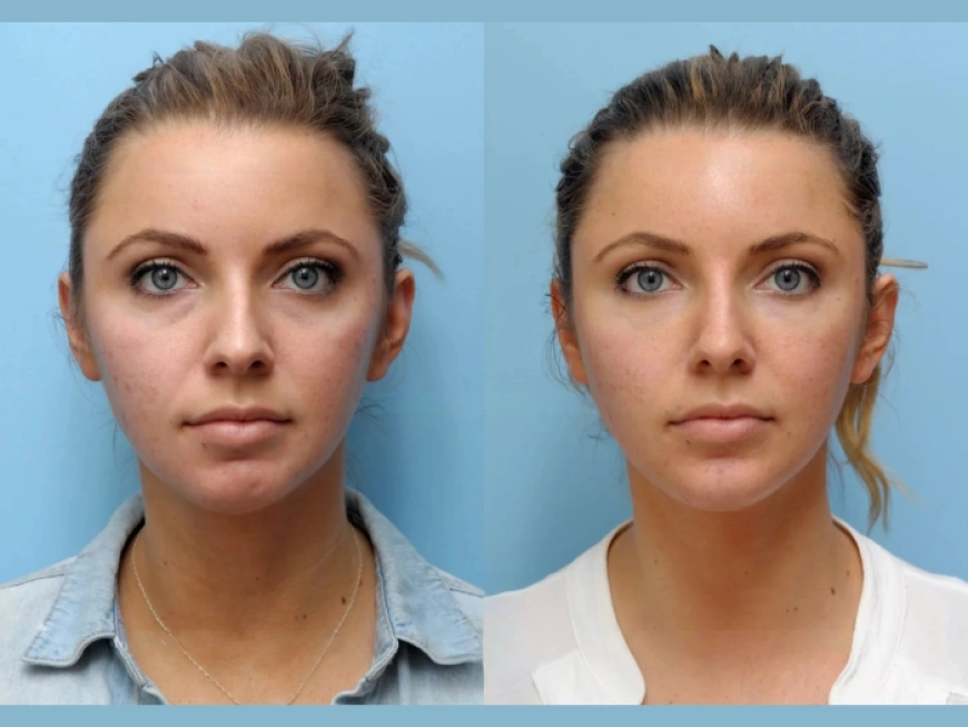 Best Plastic Surgeons in Dubai: Why Choose a Thread Lift Over a Traditional Facelift