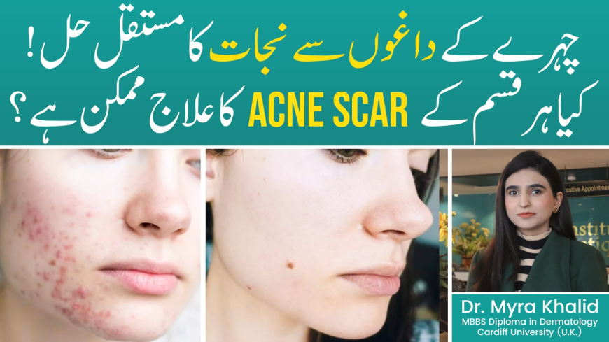 Best Acne Scar Treatments in Pakistan for Smooth, Clear Skin