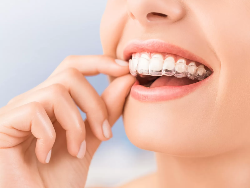 Finding the Best Clinics for Effective Invisalign Dubai Treatment