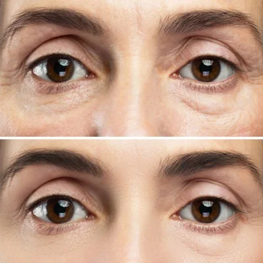 The Cost of Eyelid Bag Surgery in Dubai: What You Need to Know