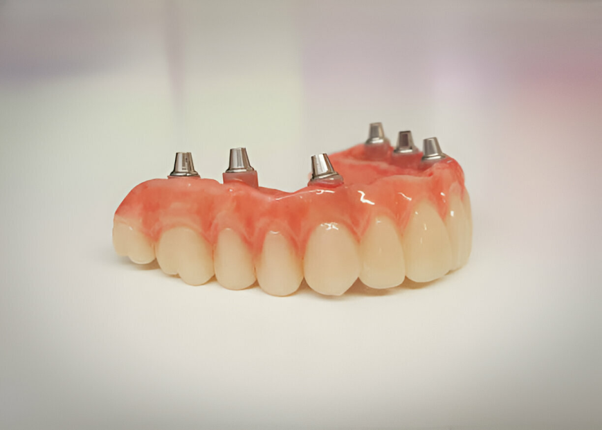 Considering Dentures in Garland, TX? Modern Options for Replacing Missing Teeth