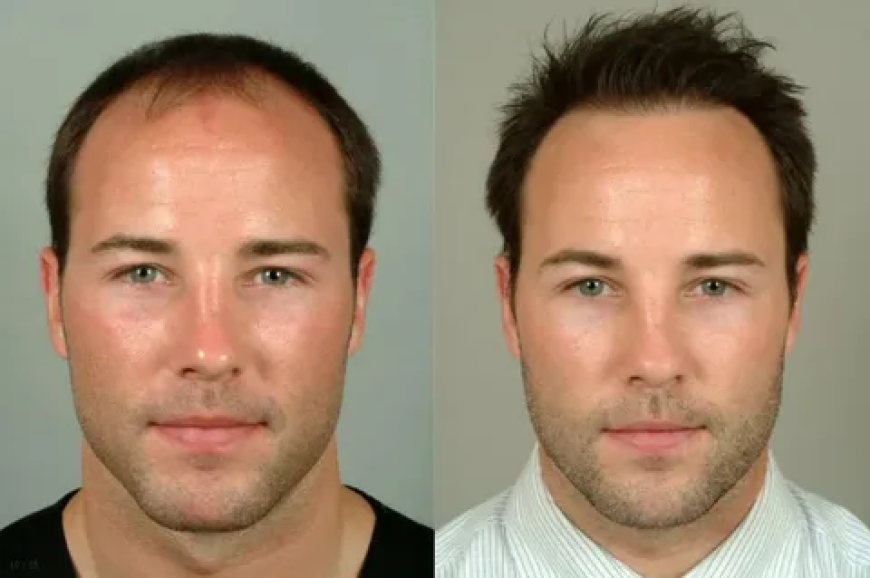 Achieving Excellence with the Best Hair Transplant in Karachi