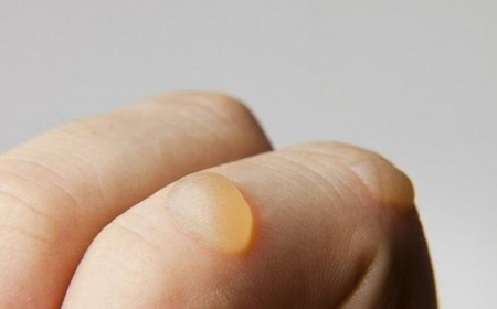 Bullous Pemphigoid Market Size, Trends, and Growth Forecast 2025–2032