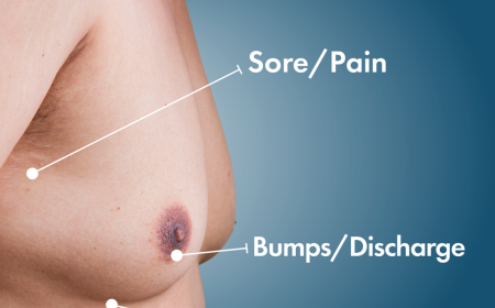 What Causes Gynecomastia in Islamabad? Symptoms, Diagnosis & Treatment