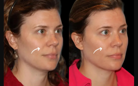Best Doctors in Dubai for Sculptra Hybrid Fillers