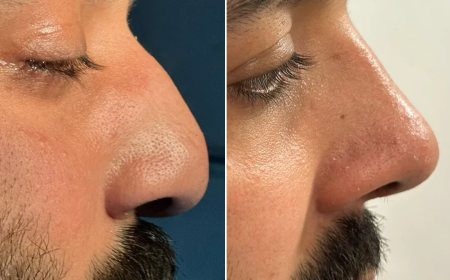 Your Complete Guide to Rhinoplasty in Islamabad: Procedure, Cost, and Recovery