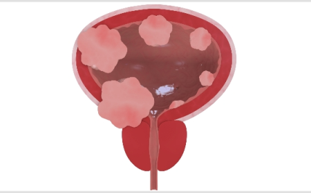 Non Muscle Invasive Bladder Cancer Market Growth and Trends Analysis 2025-2032