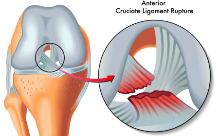 Anterior Cruciate Ligament Injuries Market: Size, Trends, and Strategic Insights