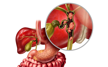 Biliary Tract Cancers Market Size, Trends, and Strategic Insights 2025-2032