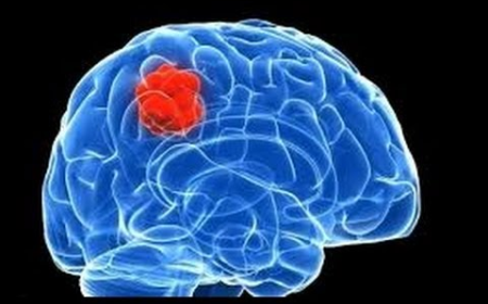 Glioblastoma Market Size, Trends, and Growth Strategies 2025-2032