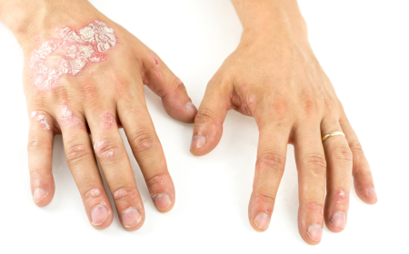 Chronic Plaque Psoriasis Market Growth, Trends, and Strategic Insights