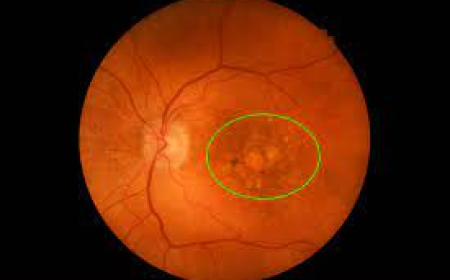 Intermediate AMD Market Size, Trends, and Growth Opportunities 2025-2032