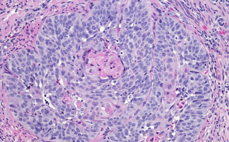 Advanced Non-Squamous and Squamous NSCLC Market: Size, Trends, and Growth Outlook