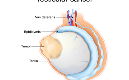 Rapid Expansion of the Testicular Cancer Drugs Market Forecast to 2032