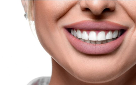Redefine Your Confidence with Hollywood Smile Makeover in Dubai