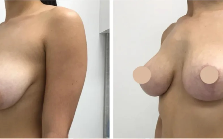 Is a Breast Lift in Dubai Worth the Cost?