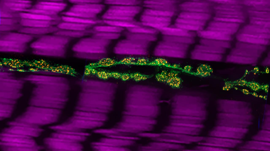 Hereditary Spastic Paraplegia Market Size, Trends, and Growth Strategies 2025-2032