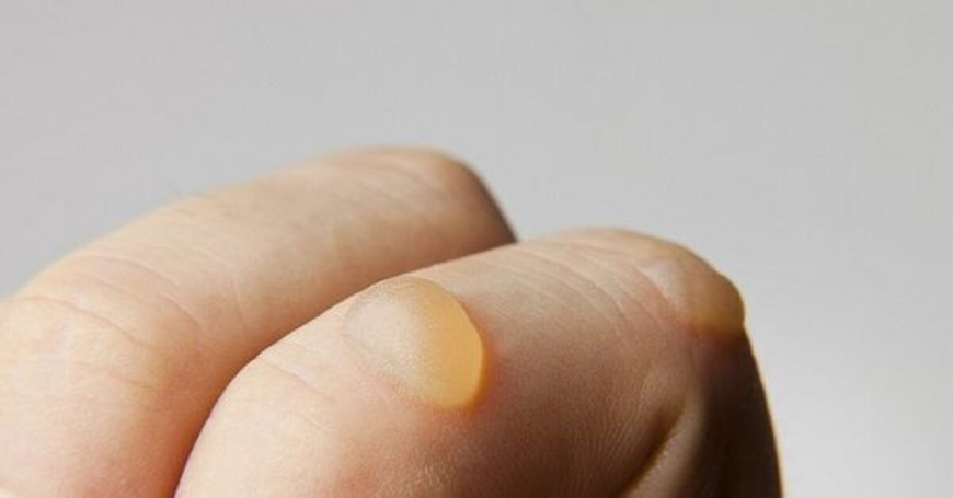 Bullous Pemphigoid Market Size, Trends, and Growth Forecast 2025–2032