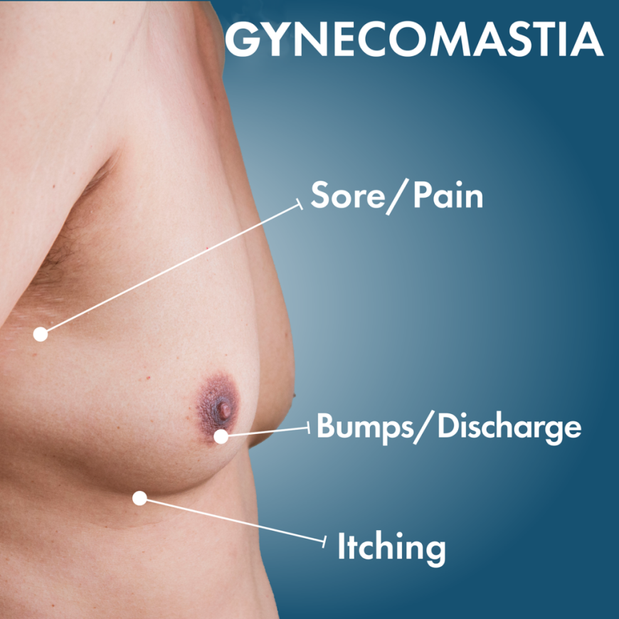 What Causes Gynecomastia in Islamabad? Symptoms, Diagnosis & Treatment