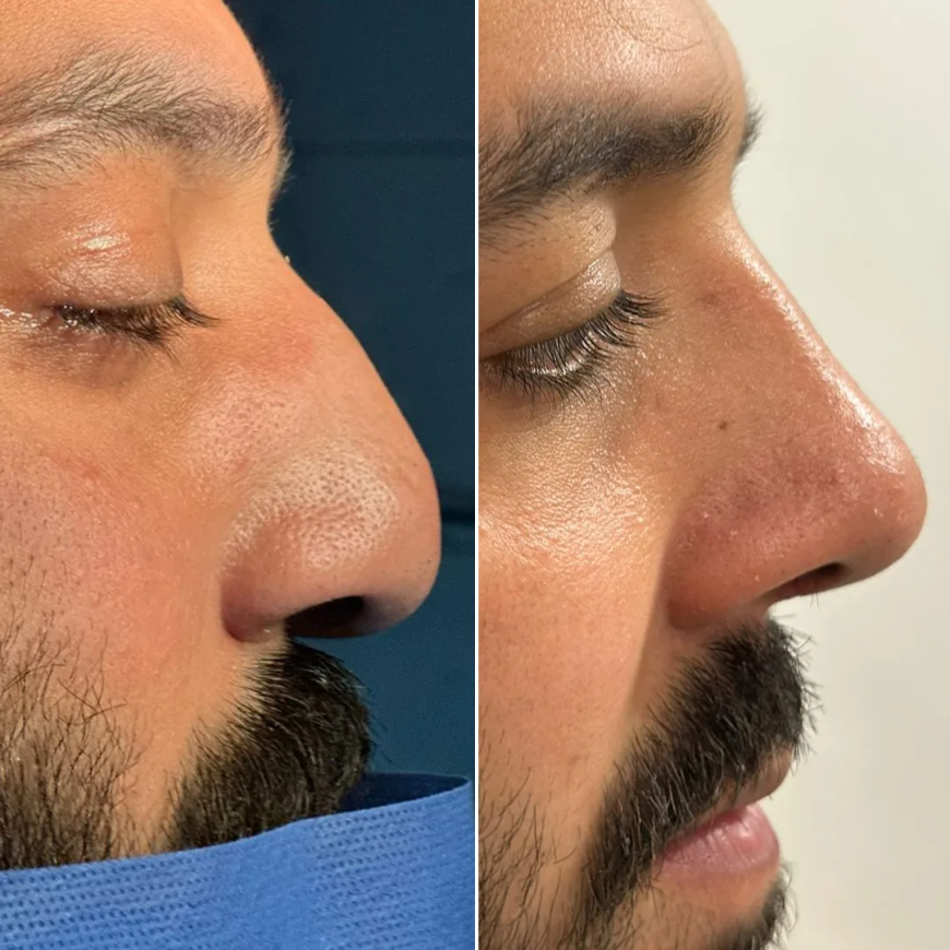 Your Complete Guide to Rhinoplasty in Islamabad: Procedure, Cost, and Recovery
