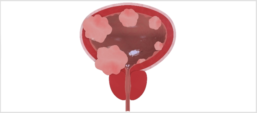 Non Muscle Invasive Bladder Cancer Market Growth and Trends Analysis 2025-2032