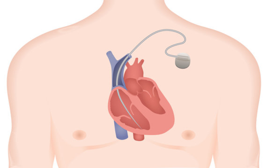 Implantable Cardiac Monitors Market : Size, Trends, and Strategic Outlook 2025-2032