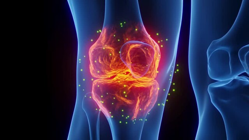 Knee Osteoarthritis Market Size, Trends, and Strategic Growth Analysis 2025-2032