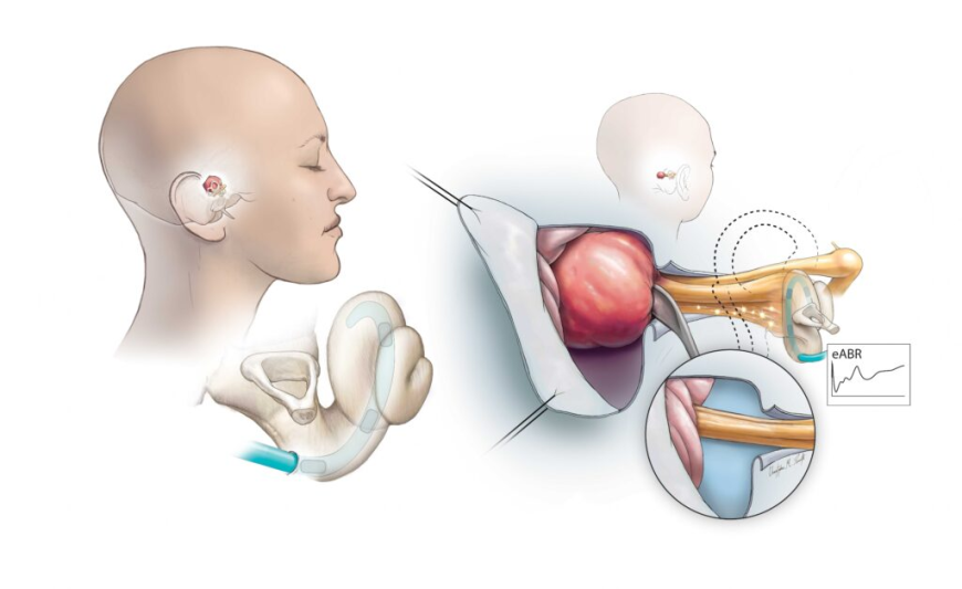Acoustic Neuroma Market Size, Trends, and Growth Strategies 2025-2032