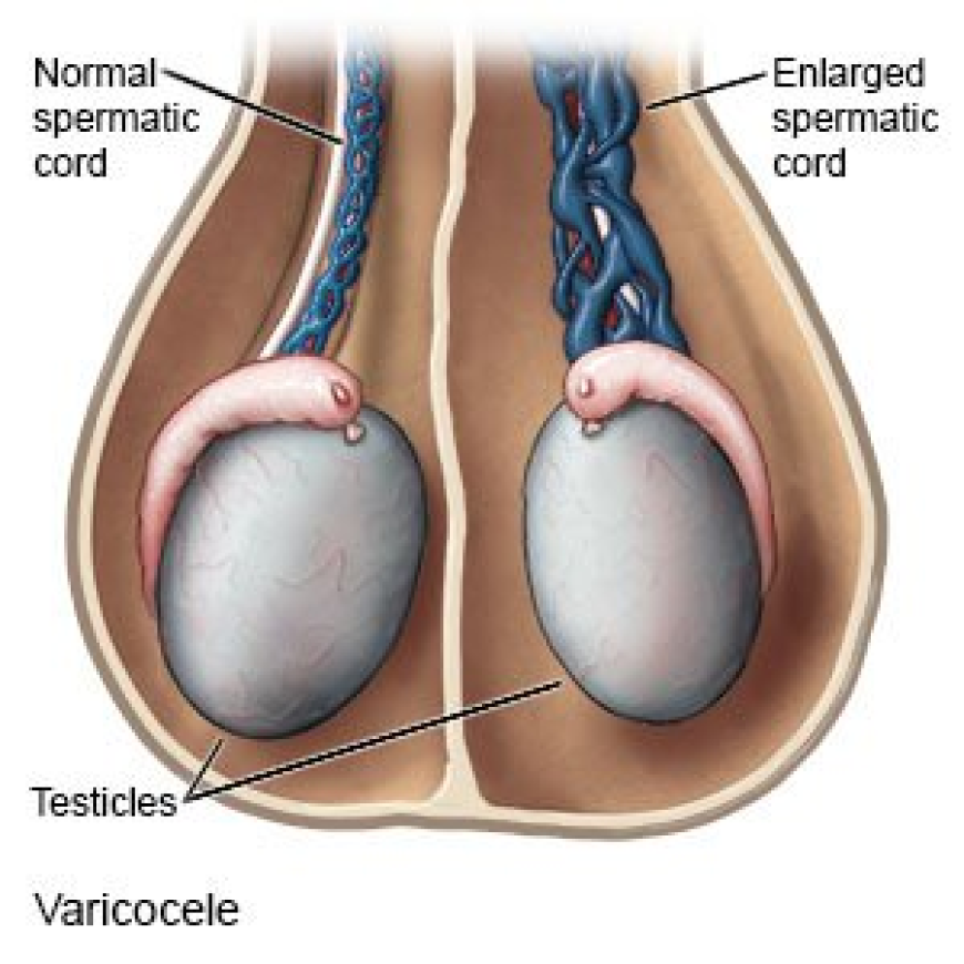 Varicocele Treatments Explained: Options, Costs & Success Rates